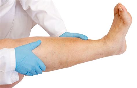 edemul picioarelor cu varice și metode de tratament